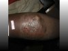 Beyond the Myths: Understanding Buruli Ulcer (Acha-ere), It's Causes and Impacts.