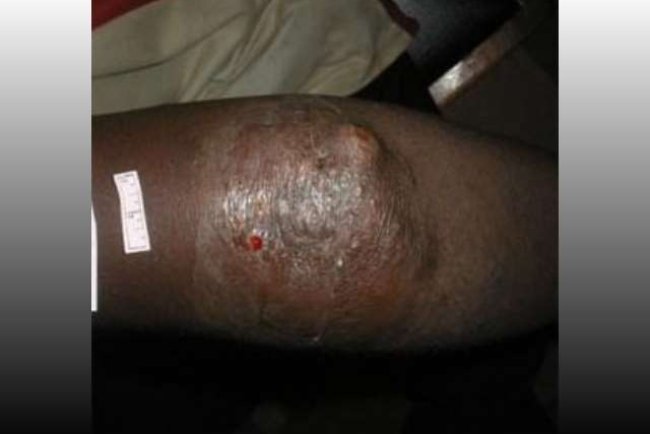 Beyond the Myths: Understanding Buruli Ulcer (Acha-ere), It's Causes and Impacts.