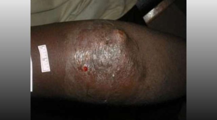 Beyond the Myths: Understanding Buruli Ulcer (Acha-ere), It's Causes and Impacts.
