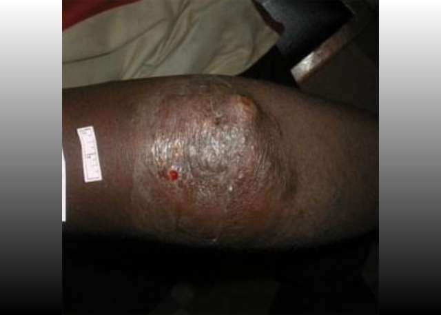 Beyond the Myths: Understanding Buruli Ulcer (Acha-ere), It's Causes and Impacts.